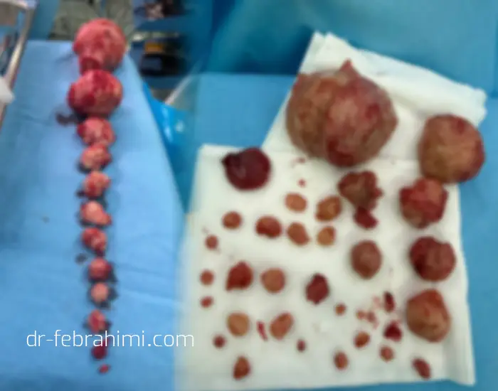 فیبروم رحمی، عمل فیبروم