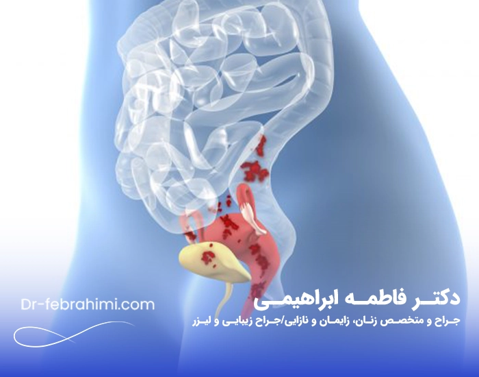 آندومتریوز، عکس آندومتریوز، دکتر آندومتریوز، دکتر زنان خوب آندومتریوز، دکتر زنان تهران