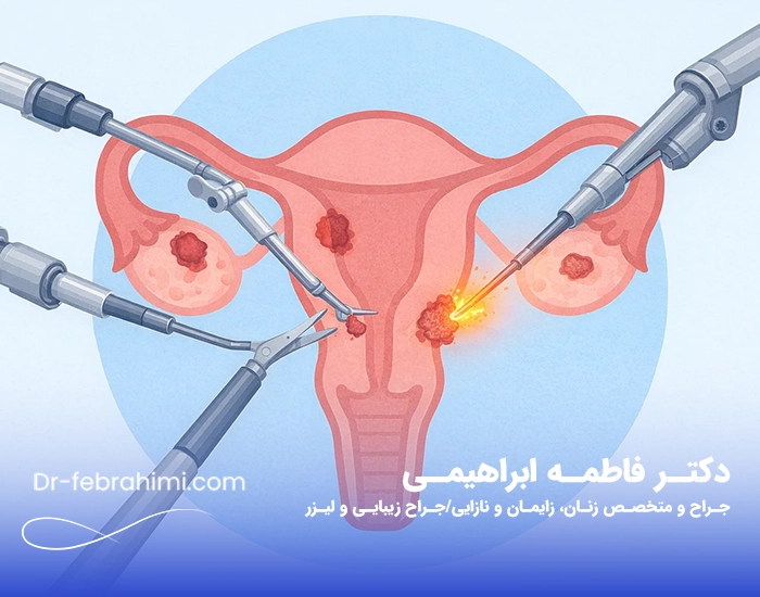 آندومتریوز، عکس آندومتریوز، دکتر آندومتریوز، دکتر زنان خوب آندومتریوز، دکتر زنان تهران