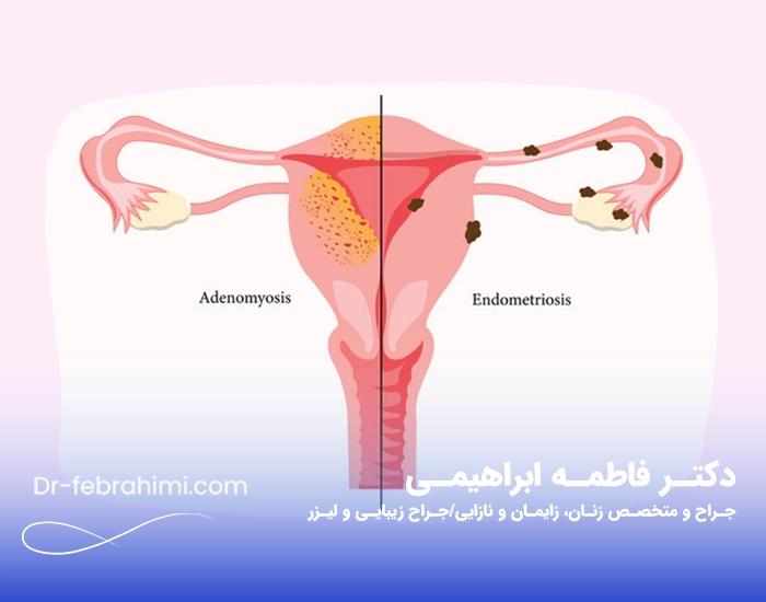 آندومتریوز، عکس آندومتریوز، دکتر آندومتریوز، دکتر زنان خوب آندومتریوز، دکتر زنان تهران