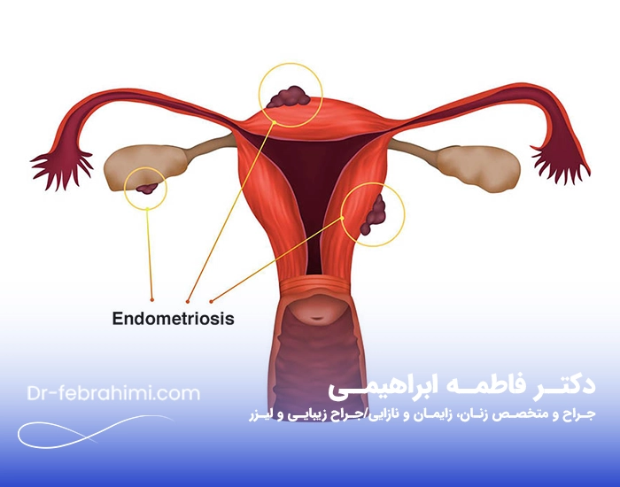 آندومتریوز، عکس آندومتریوز، دکتر آندومتریوز، دکتر زنان خوب آندومتریوز، دکتر زنان تهران