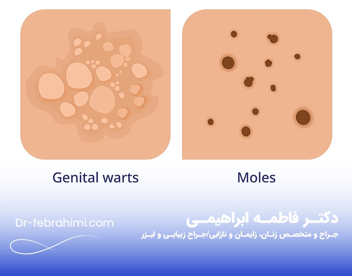 زگیل تناسلی، درمان زگیل، زگیل جنسی، دکتر زگیل، دکتر خوب زنان در تهران