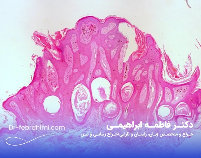 زگیل تناسلی، درمان زگیل، زگیل جنسی، دکتر زگیل، دکتر خوب زنان در تهران