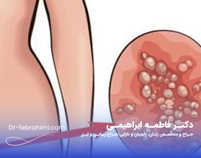زگیل تناسلی، درمان زگیل، زگیل جنسی، دکتر زگیل، دکتر خوب زنان در تهران