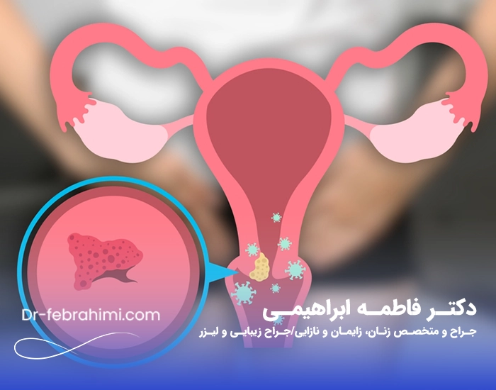 زگیل تناسلی، درمان زگیل، زگیل جنسی، دکتر زگیل، دکتر خوب زنان در تهران