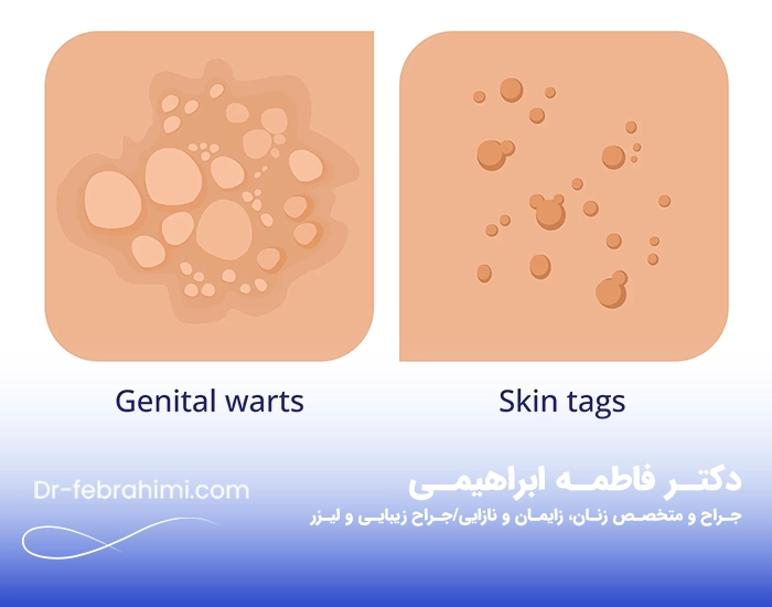 زگیل تناسلی، درمان زگیل، زگیل جنسی، دکتر زگیل، دکتر خوب زنان در تهران