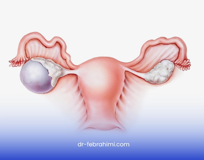 کیست تخمدان، درمان کیست تخمدان، پزشک زنان، جراح زنان خوب کیست