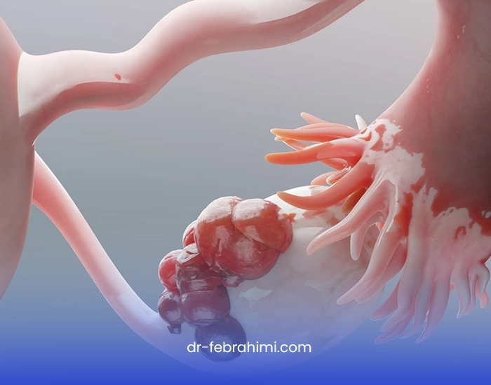 کیست تخمدان، درمان کیست تخمدان، پزشک زنان، جراح زنان خوب کیست