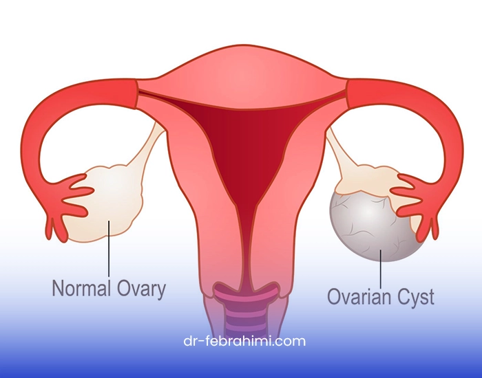 کیست تخمدان، درمان کیست تخمدان، پزشک زنان، جراح زنان خوب کیست