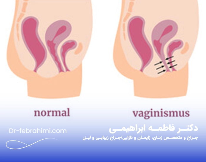 درمان واژینیسموس، پزشک زنان، دکتر واژینیسموس تهران