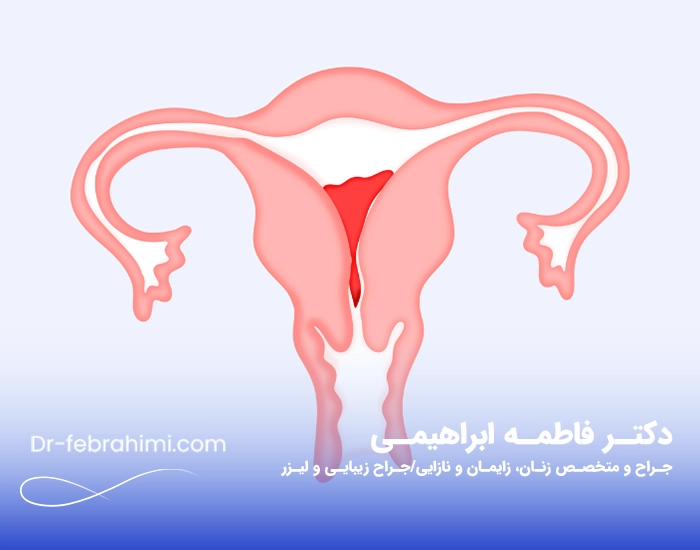 درمان واژینیسموس، پزشک زنان، دکتر واژینیسموس تهران